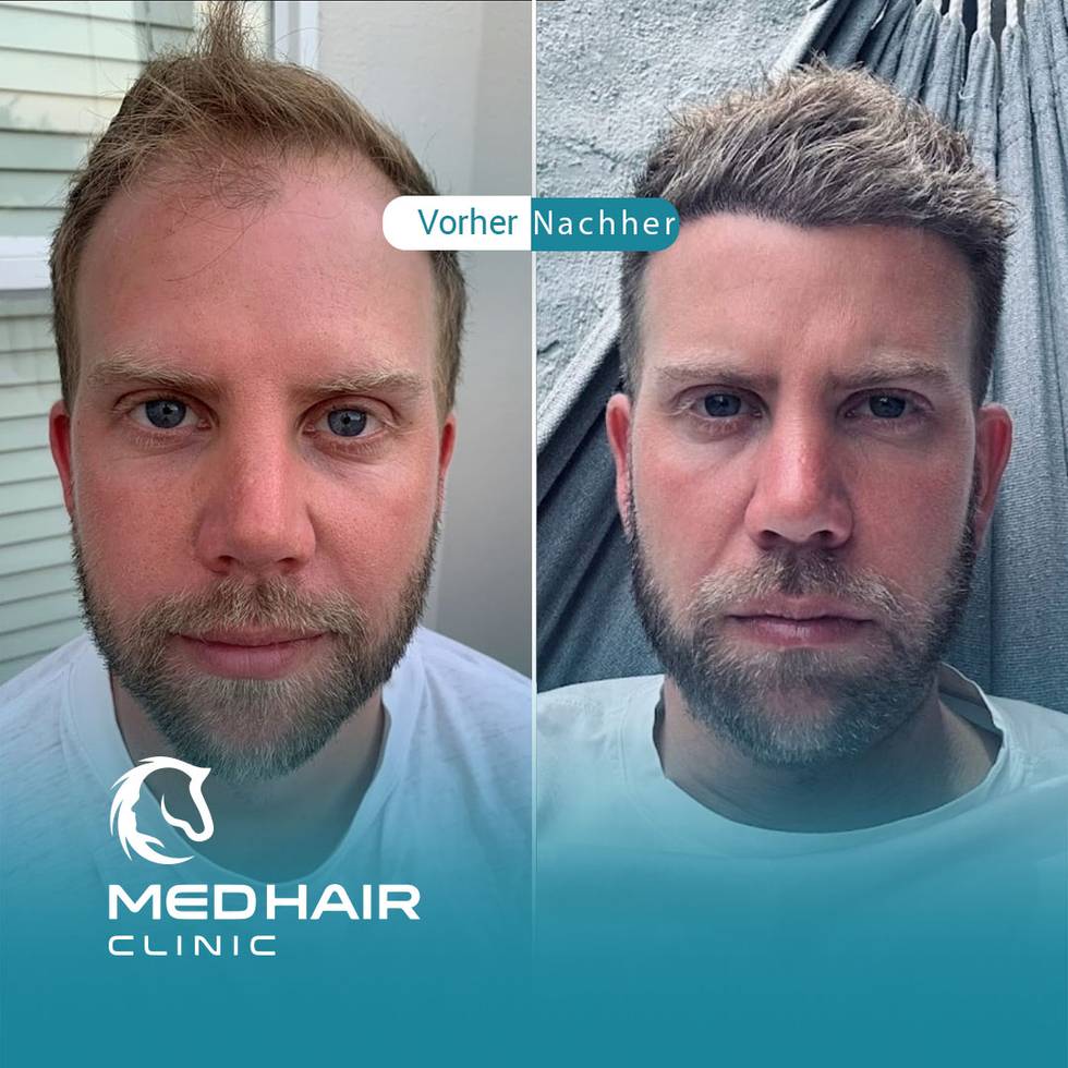 haartransplantation-vorher-nachher.jpg