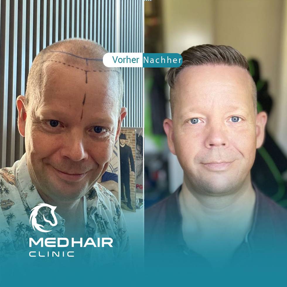 haartransplantation-tuerkei-vorher-nachher-3000-grafts.jpg